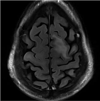 Figure 1 – Typical MRI findings of PML