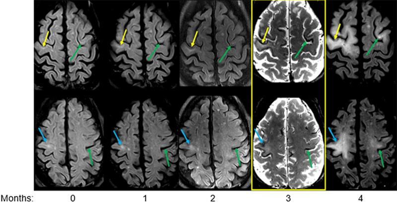 Progression of PML lesions on MRI brain