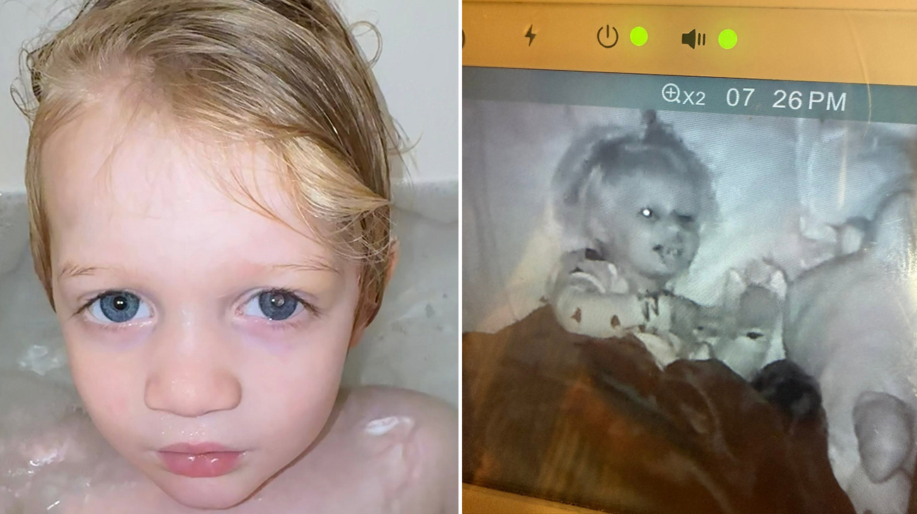 Miley's mother noticed Miley had a black eye on a baby monitor.