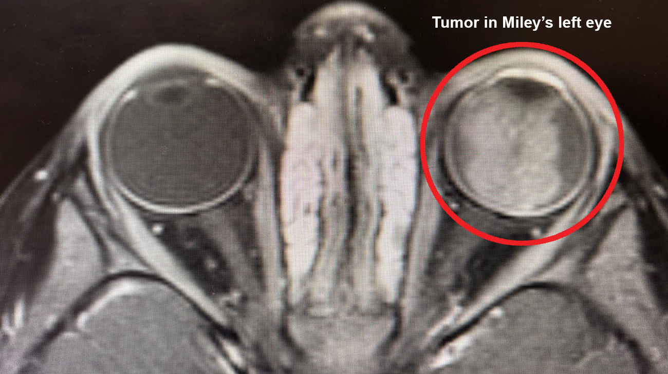 Tumor behind Miley's left eye.