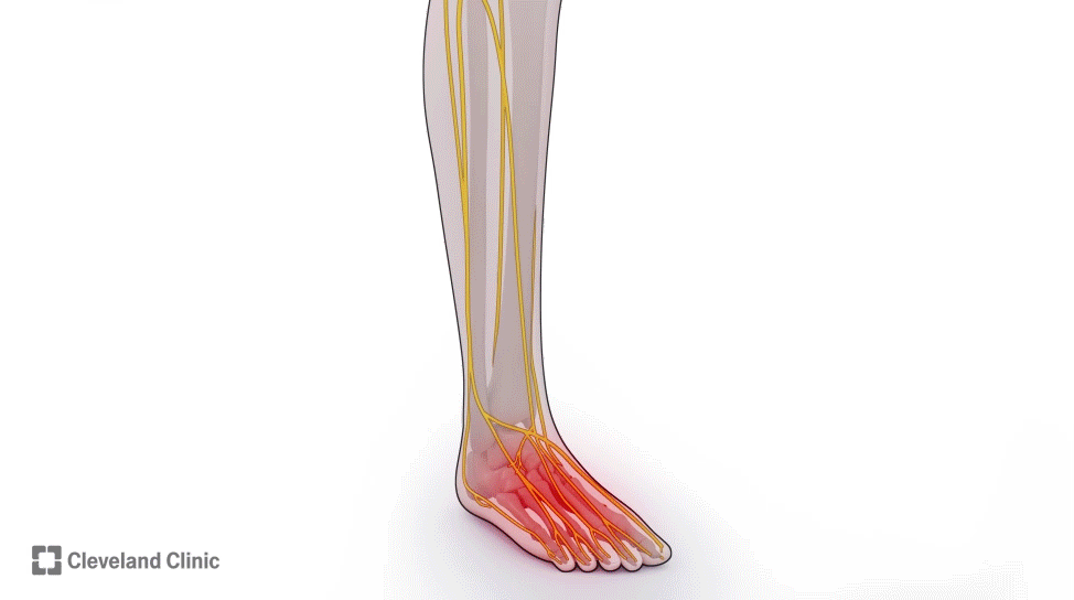 Animation of Scrambler Therapy