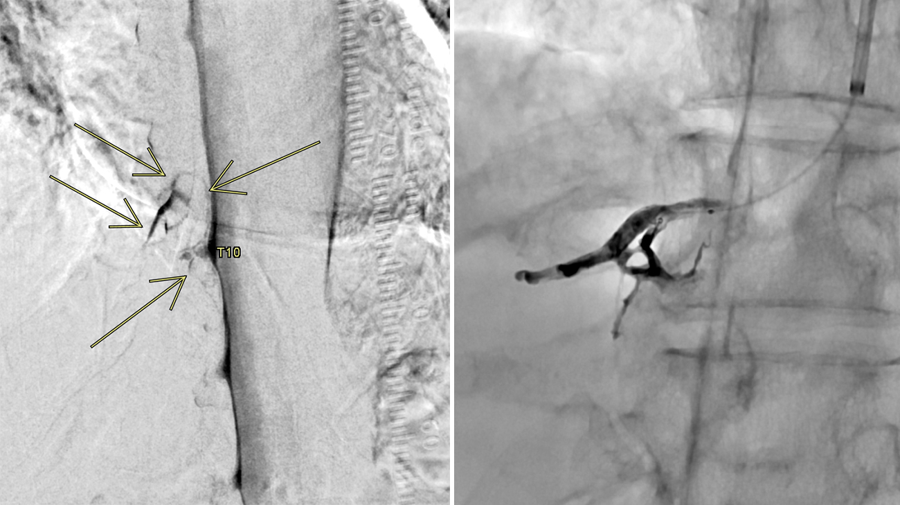 Scans related to Dee Dee Nealey's rare cerebrospinal fluid (CSF) leak.