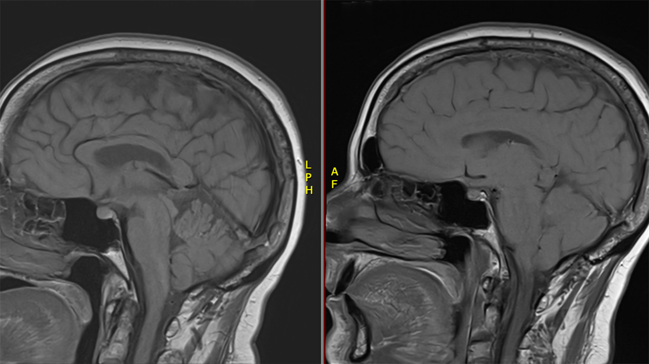 Before (right) and after (left) MRI scans show the impact of treatment for a spinal fluid leak. Once the leak was sealed, the brain returned to a more normal position.