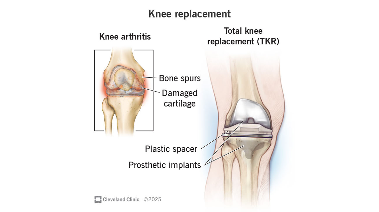 Cleveland Clinic illustration of a knee replacement.