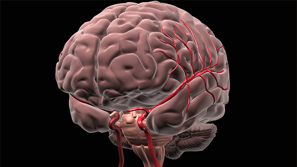 Bleeding deep in the brain usually occurs when small vessels break and blood is allowed to enter into the brain tissue. Hypertension or high blood pressure is the most common reason these small blood vessels break. (Courtesy: Cleveland Clinic)