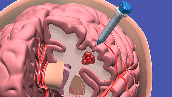 To access a deep brain hemorrhage in a minimally invasive way a small opening is made in the skull. The sheath is passed through the sulci or wrinkles in the brain. Once the sheath reaches the hematoma the inner blue obturator is removed and the hemorrhage is removed with the myriad device. (Courtesy: Cleveland Clinic animation)