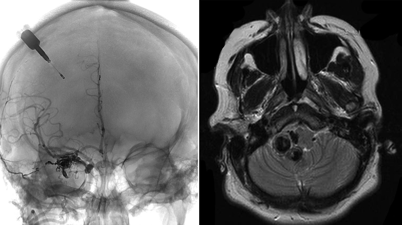 Cleveland Clinic doctors diagnosed Jennifer with arteriovenous malformation (AVM), a tangled web of arteries and veins in her brain. (Courtesy: Cleveland Clinic)