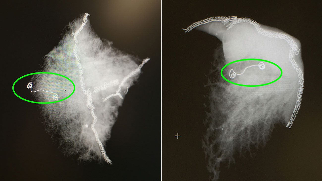 X-ray images of lung samples with the microcoil. (Courtesy: Cleveland Clinic)