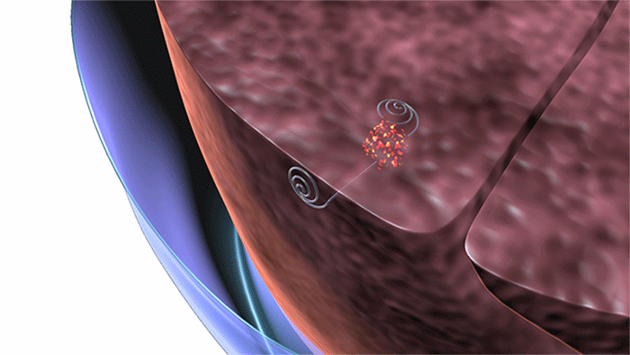 A thoracic surgeon locates the coil and resects it along with the wedge of tissue containing the small nodule or lesion. (Courtesy: Cleveland Clinic)