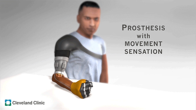 Animation of how illusory movement perception improves motor control for prosthetic hands. (Courtesy: Cleveland Clinic)