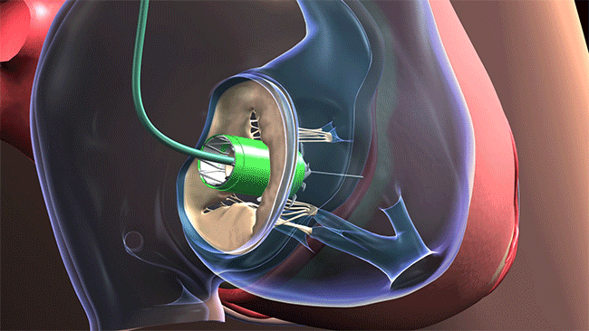 Cleveland Clinic surgeons were the first in the nation to perform this innovative heart valve surgery through the jugular vein in the neck. (Courtesy: Cleveland Clinic)