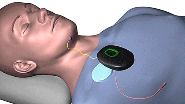 Using a remote, the implantable device synchronizes the tongue and palate movements to open key airway muscles throughout the night. (Courtesy: Cleveland Clinic)