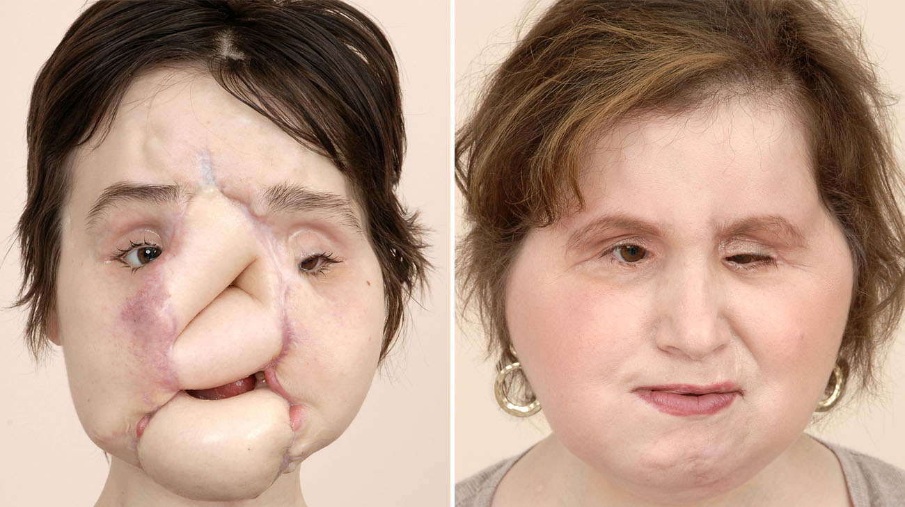 Katie Stubblefield before her face transplant in March 2015 and after in August 2018. (Courtesy: Cleveland Clinic)