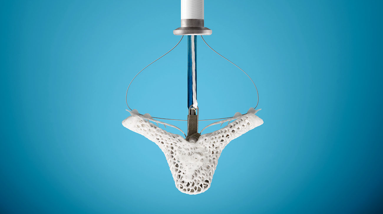 A transcatheter mitral valve repair device is used to treat mitral regurgitation without invasive surgery. (Courtesy: Abbott)