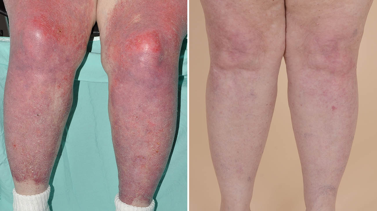 Cleveland Clinic patient with classic dermatomyositis skin condition. 