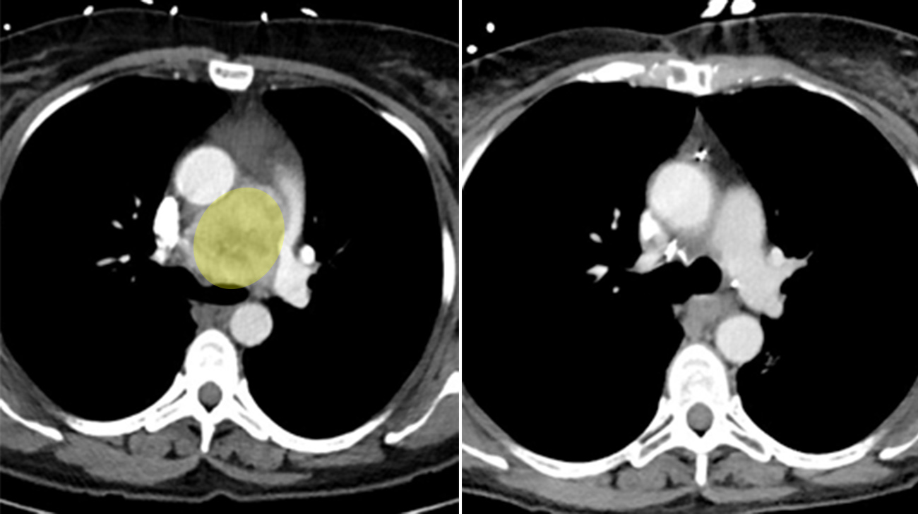The tumor was the size of a tennis ball before radiation (left). Even though the treatment shrunk the tumor (right), doctors still needed to complete surgery. (Courtesy: Cleveland Clinic)