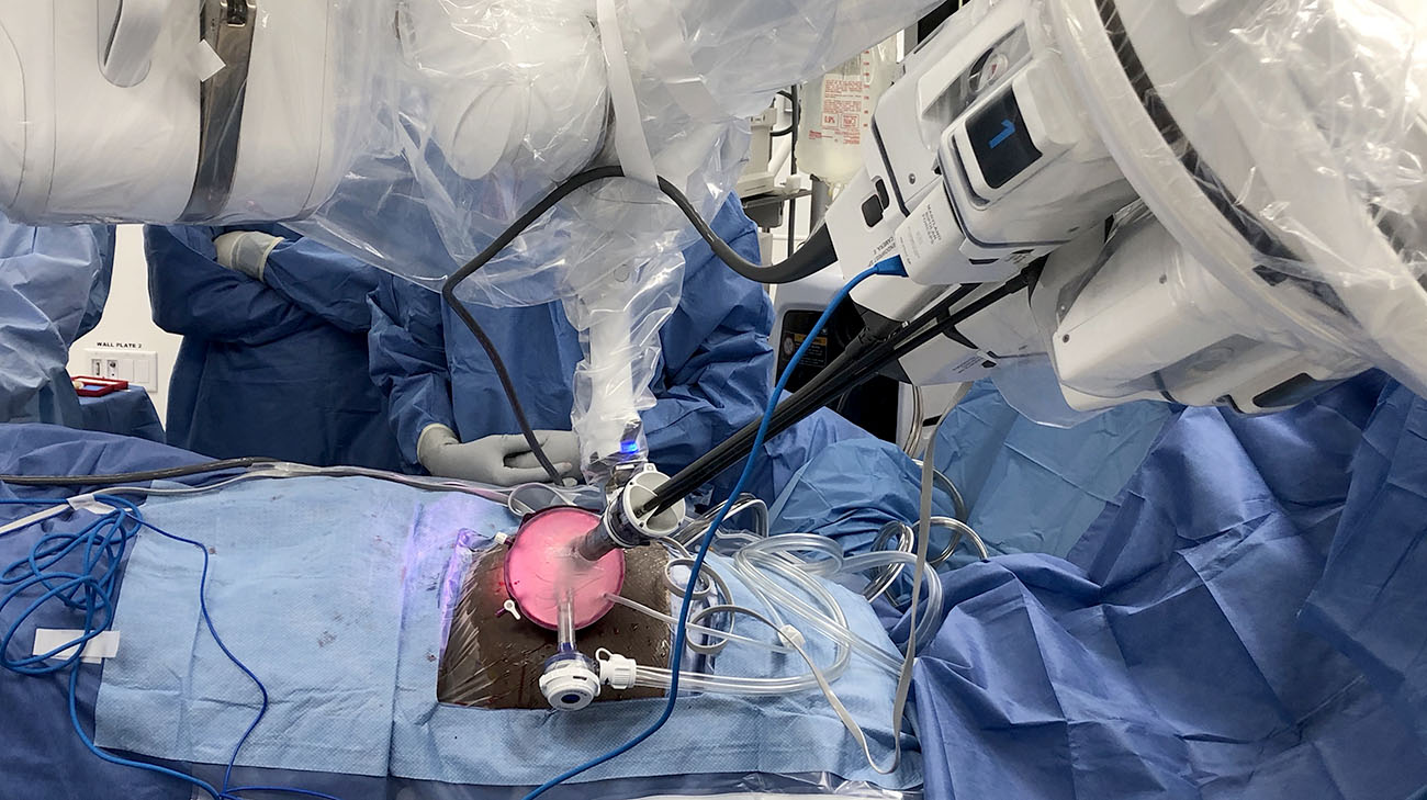 The single-port robot allows all the surgical instruments to be placed through one small incision. (Courtesy: Cleveland Clinic)