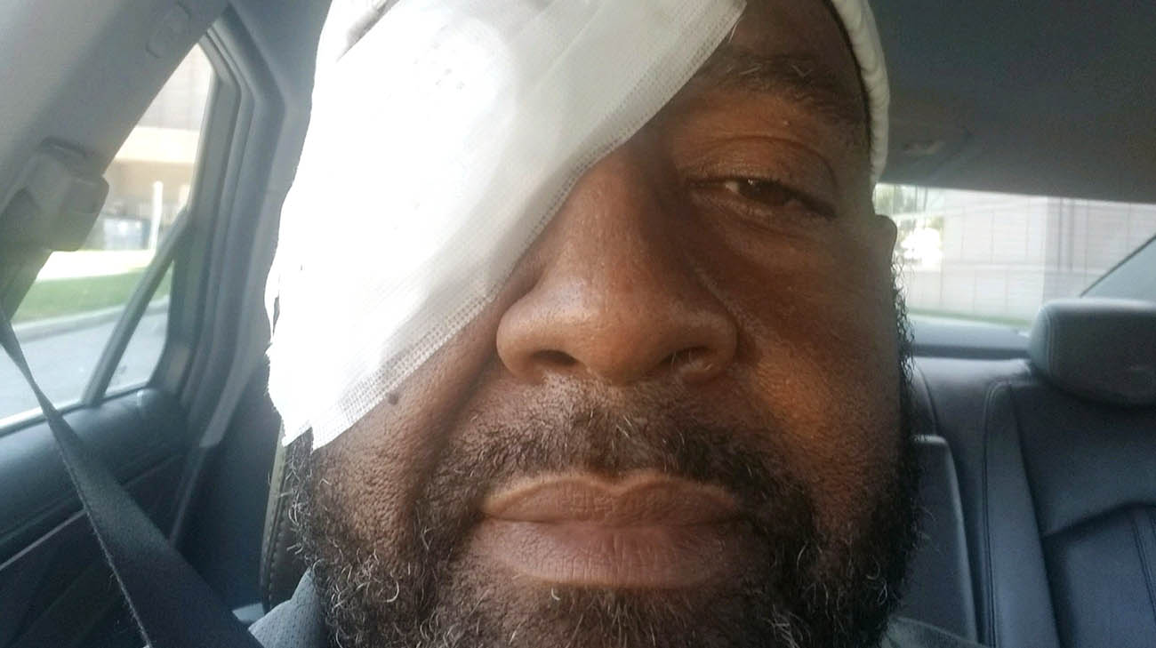 Mark after his eye surgery at Cleveland Clinic for diabetic retinopathy. 