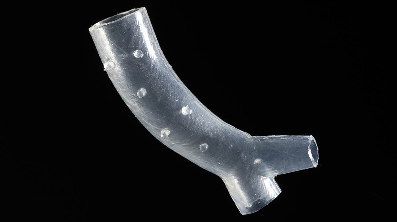 3D airway stent created by Cleveland Clinic interventional pulmonologist Dr. Thomas Gildea.