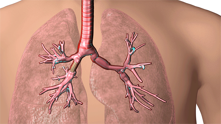 3D airway stent created by Cleveland Clinic interventional pulmonologist Dr. Thomas Gildea.