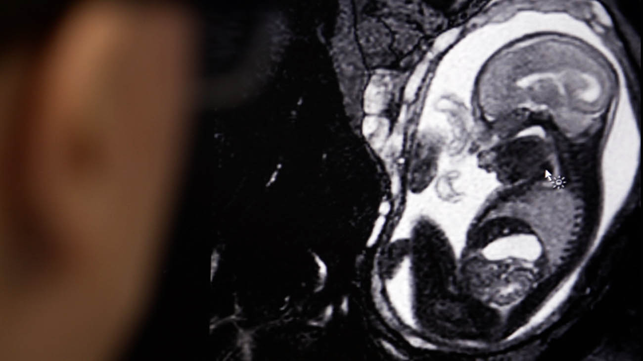 MRI of fetus with spina bifida. 