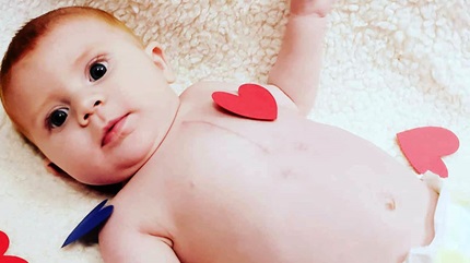 Carson was born with a congenital heart defect called aortic stenosis. 