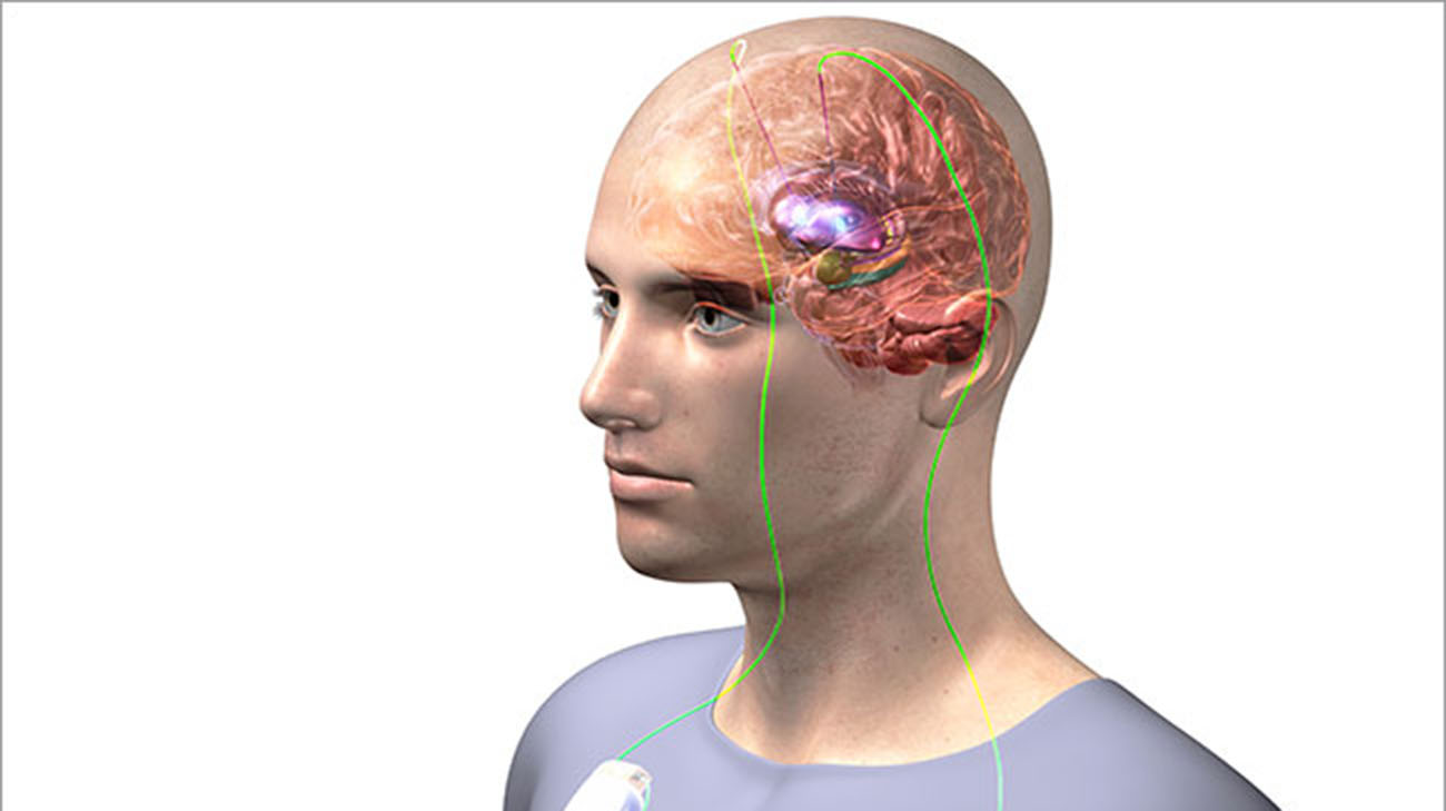Deep Brain Stimulation involves implanting electrodes in the brain, which deliver electrical impulses to correct abnormal brain cell activity. (Courtesy: Cleveland Clinic)