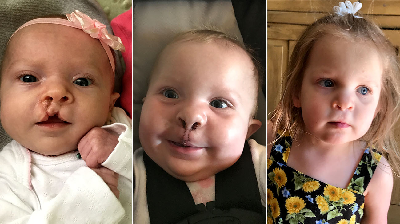 Charlotte had several surgeries to repair her cleft lip and palate, and will have more as she continues to grow. (Courtesy: Emily Whiting)