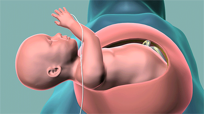 Surgery Removes Large Mass on Baby's Lung Before Birth