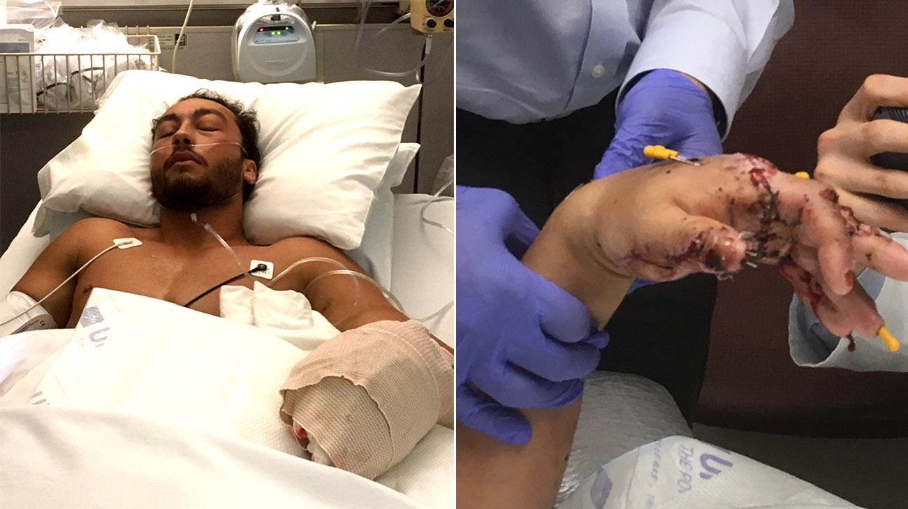 Surgeon Dr. William Lanzinger had to put pins in every one of Luke's fingers.