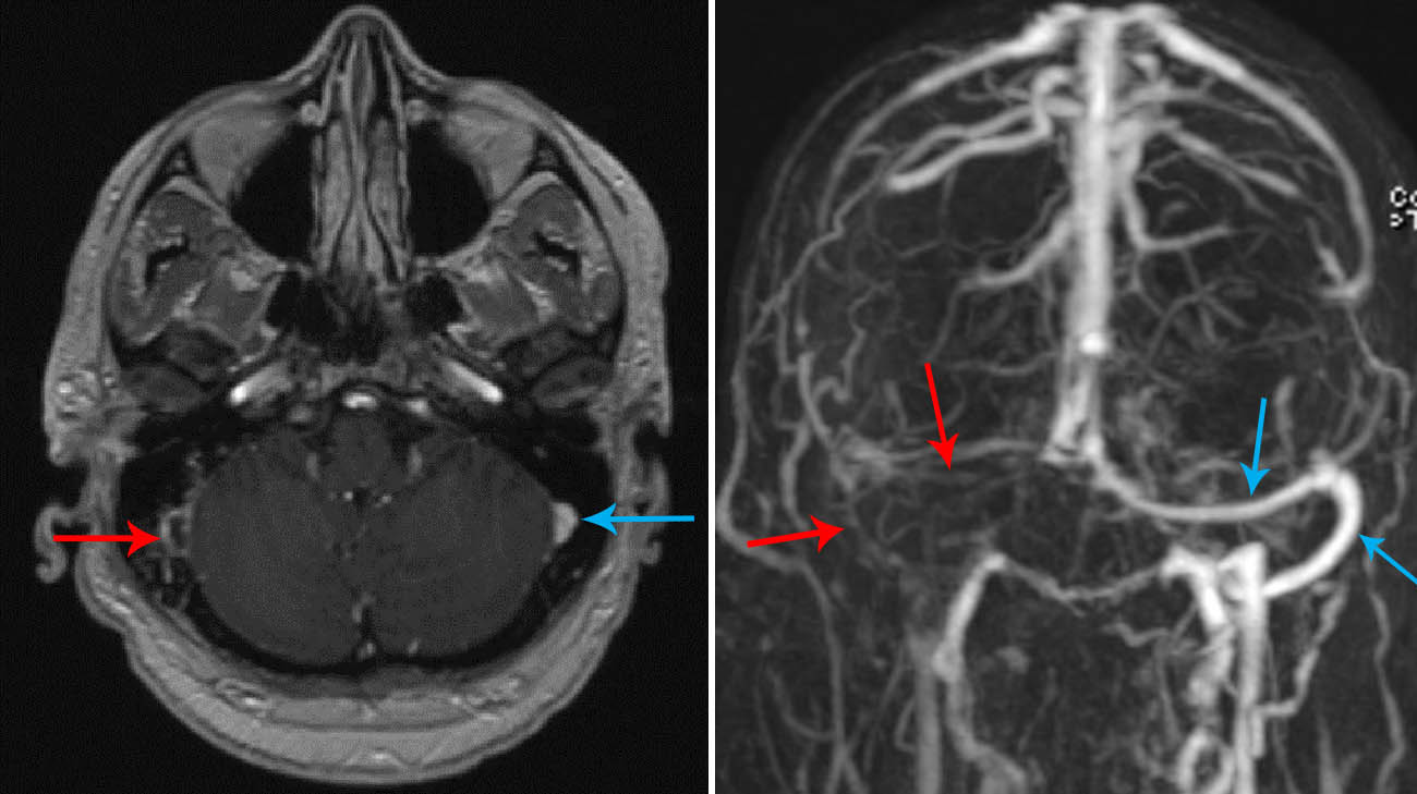 Tim's stroke related scans while he was recovering fro COVID-19. 