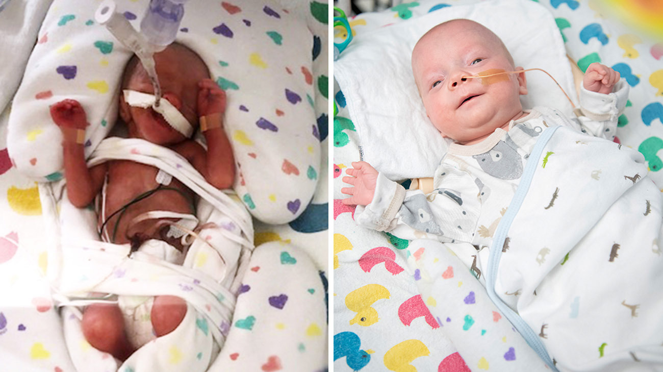 Premature Baby Girl In Hospital