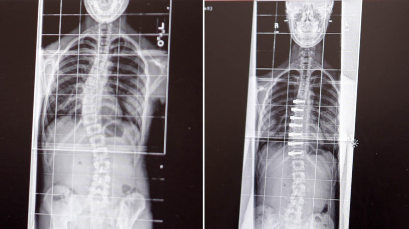 Aubrey's scans before tethering and after. 