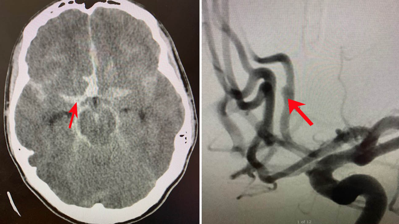 CT scan of Robbie’s brain showing his subarachnoid hemorrhage as the white area in the center. Cerebral angiogram showing his aneurysm. 