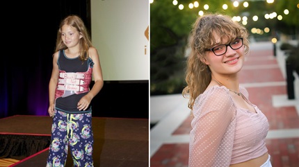 Left: Young Anna With Nighttime Brace. Right: Anna Post-Surgery
