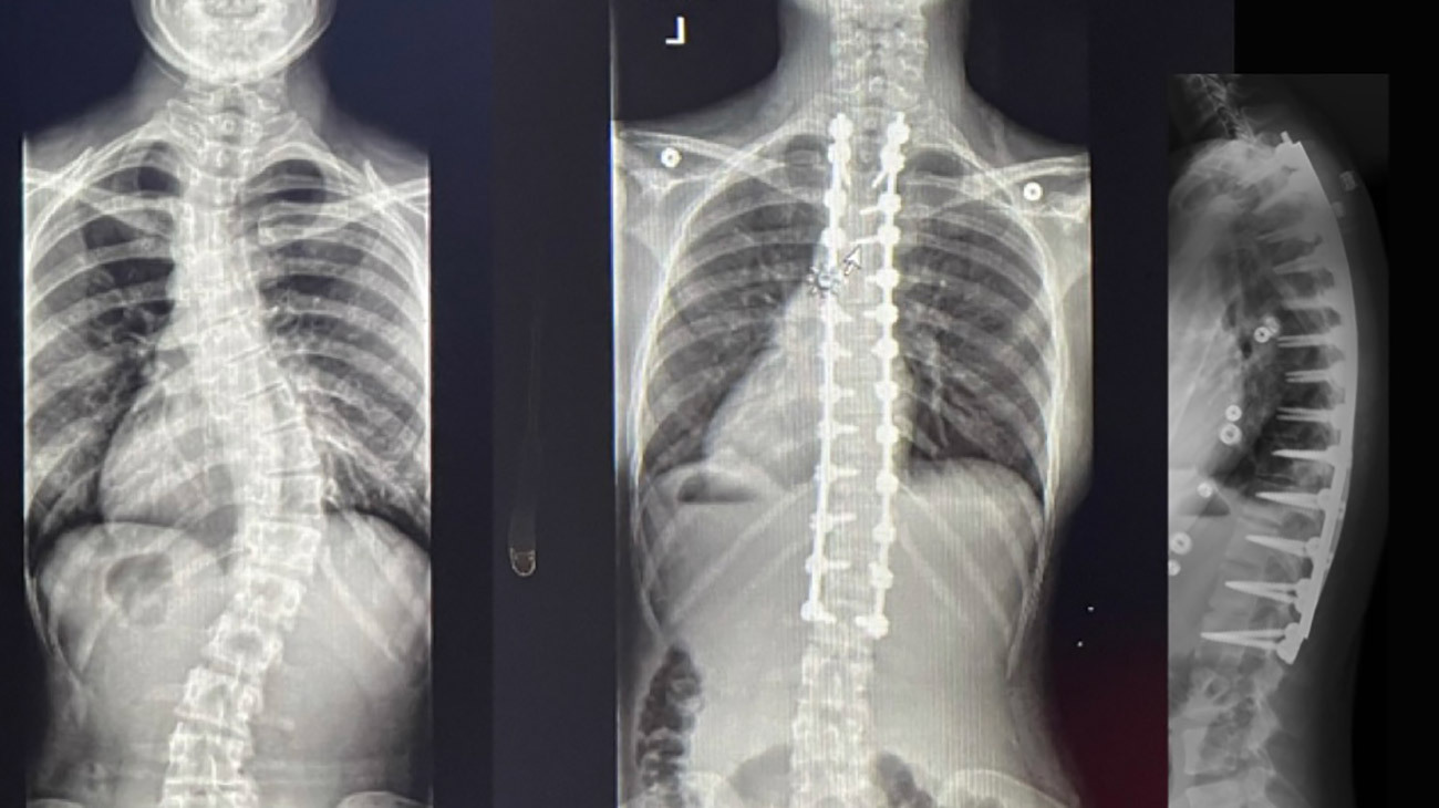 Anna Browning's Spine X-rays - Before and After