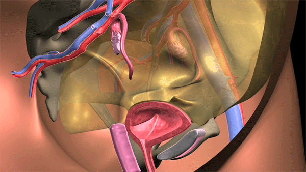 Animation of a uterus transplant.