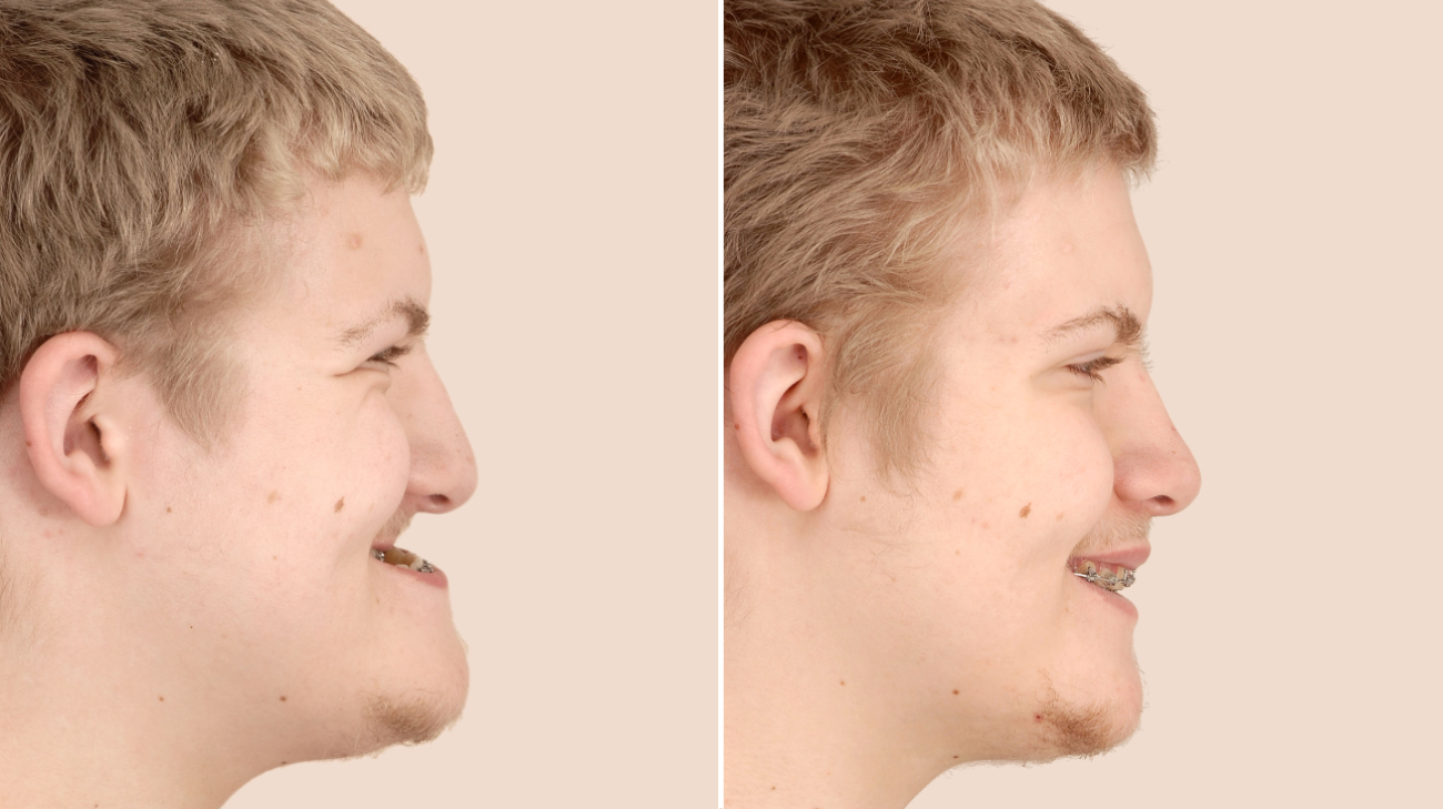 Before and after: Born with a severe underbite, Jack underwent surgery to reposition his upper and lower jaw bones and to add cheek implants.