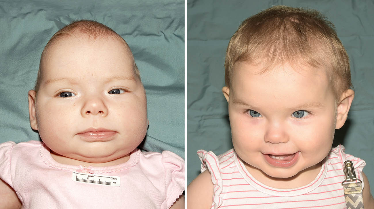 Charlotte before and after undergoing open cranial surgery.
