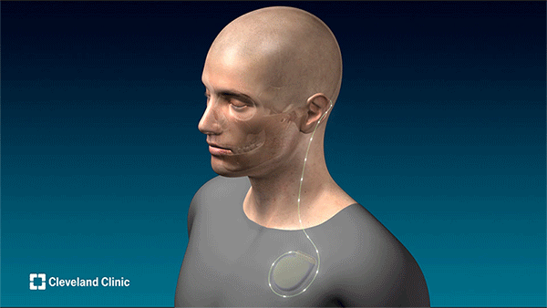 Deep brain stimulation for patients who experience a stroke.