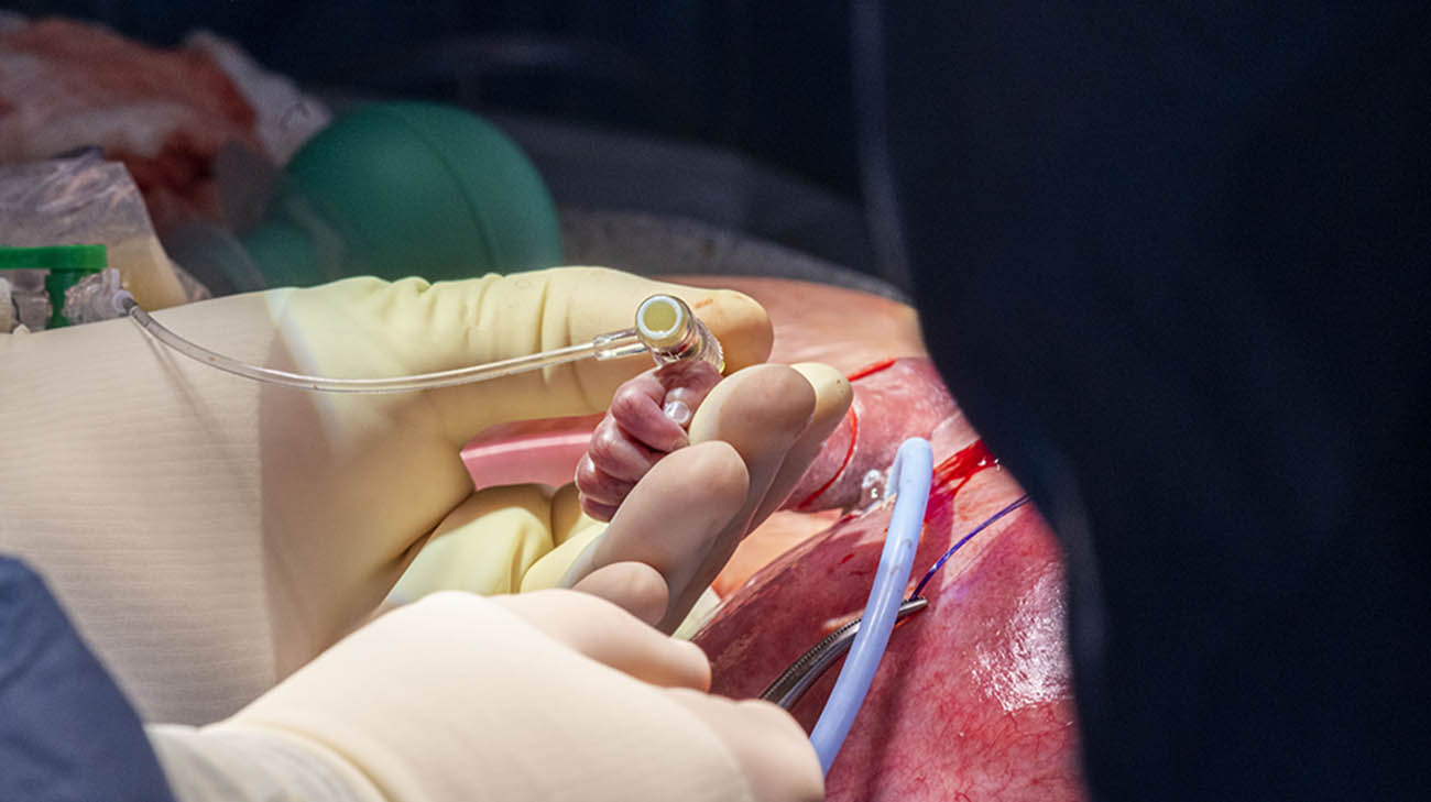 Dr. Hani Najm, who led the heart surgery team, inserts an IV line in the fetus’s right arm to deliver fluids and medications as needed. 