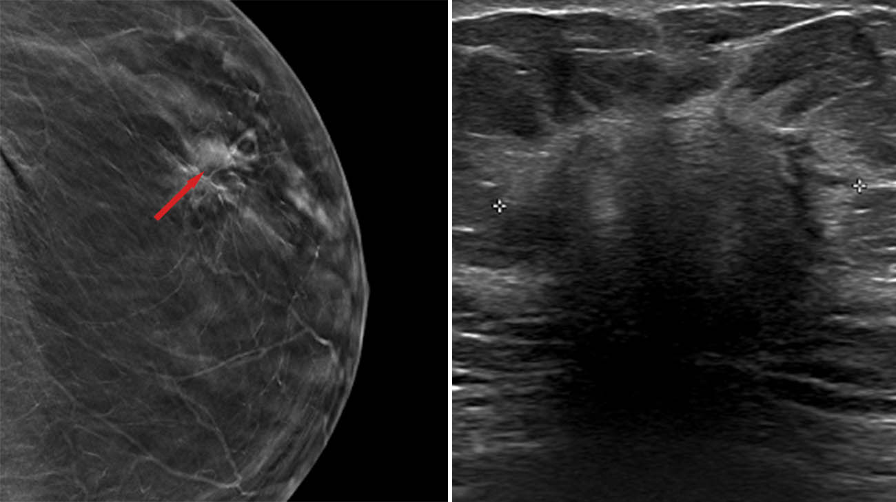 A mammogram and ultrasound of Virgie's breast cancer. 