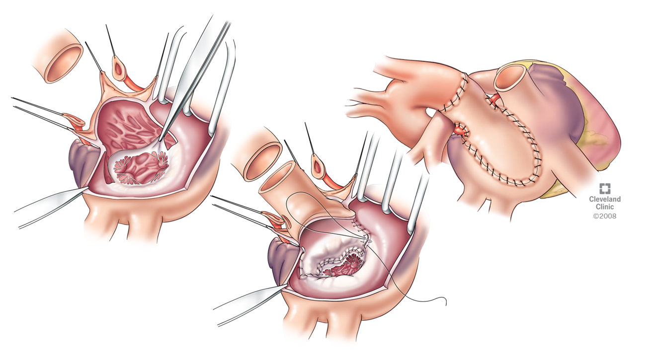 Cleveland Clinic illustration of a hemi-commando heart procedure. 