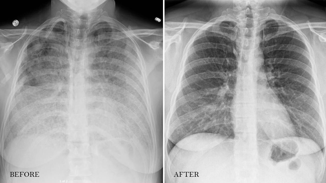 Paula's lungs before and after undergoing the whole-lung lavage. 