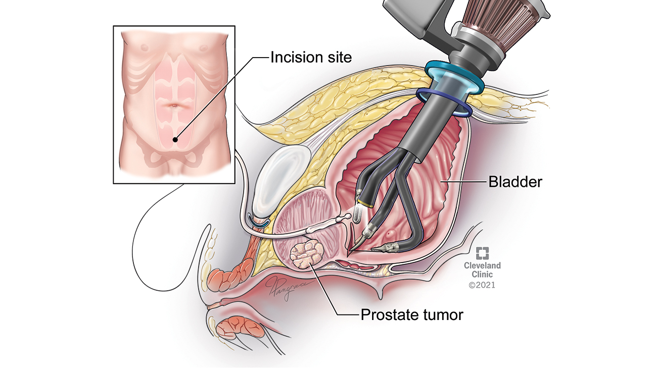 Single arm robotic transvesical bladder prostatectomy at Cleveland Clinic.