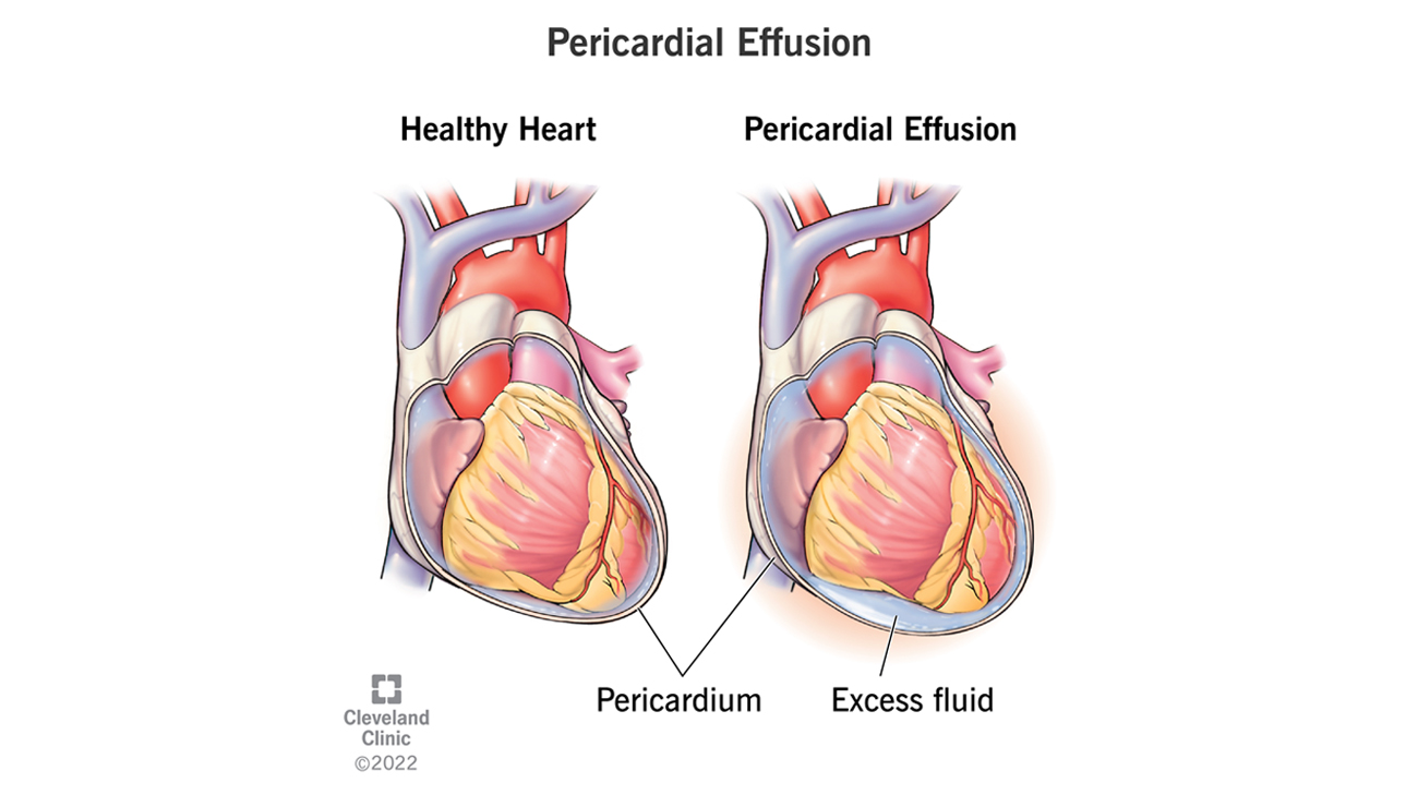 Illustration of pericardial effusion. 