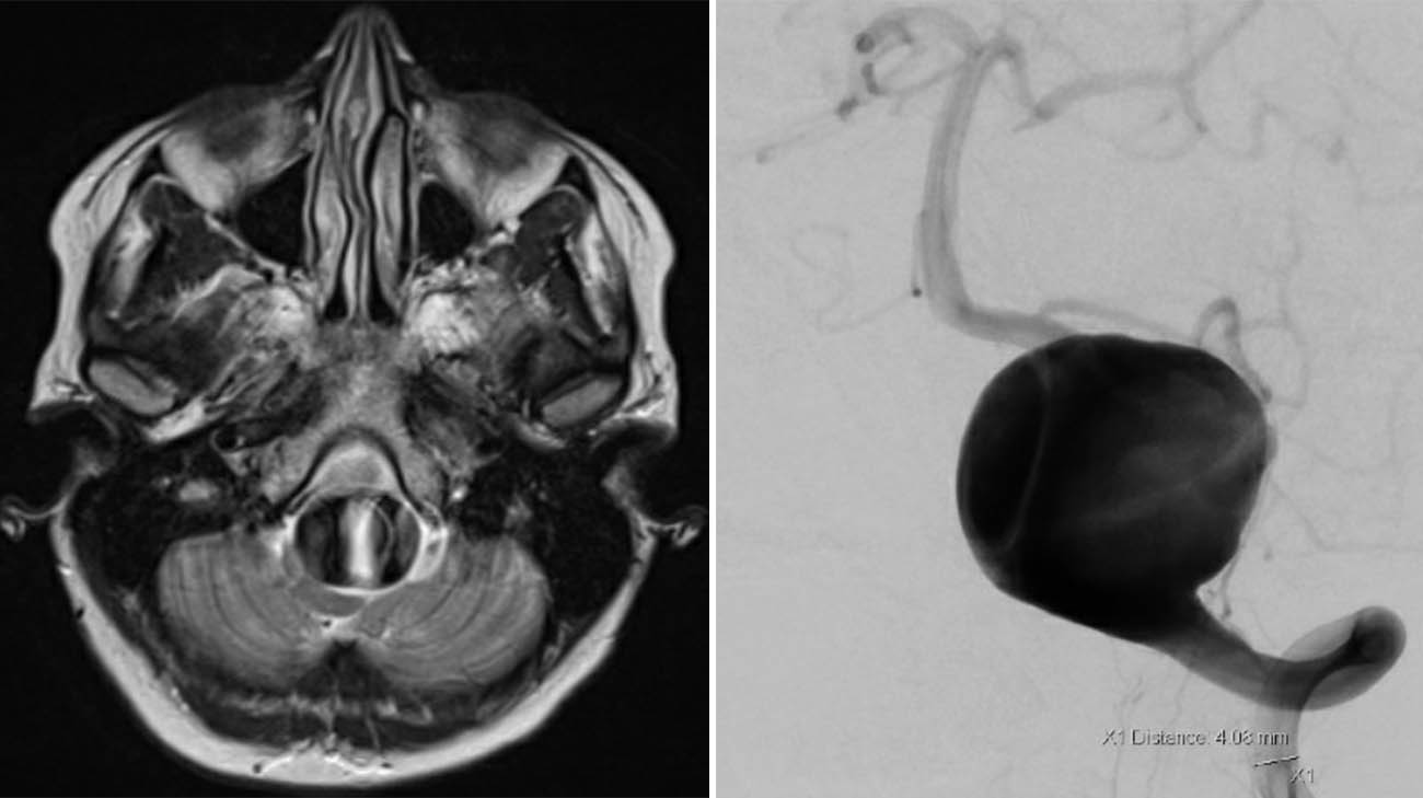 Brain scans of Mallory's brain aneurysm.