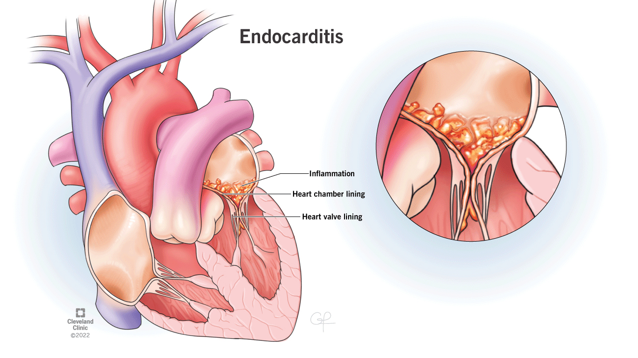 Endocarditis is an inflammation of a person’s heart valves and chambers.