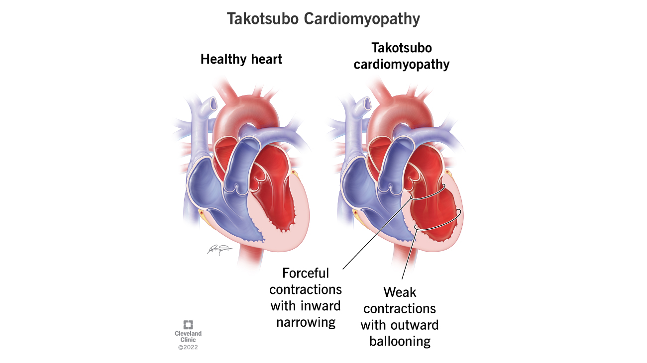 Cleveland Clinic illustration of takotsubo cardiomyopathy or broken heart syndrome. 
