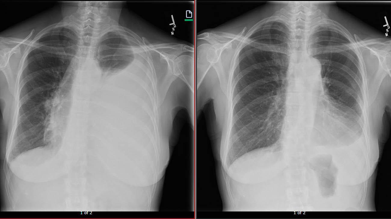 Prior to undergoing CAR T-cell therapy, doctors had to remove fluid that had built up in Sue's lungs.